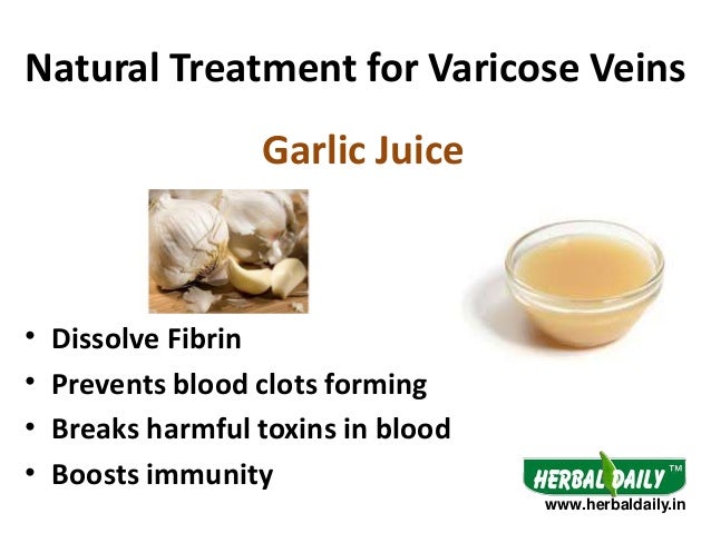 herbal remedies for varicose veins herbal remedies for varicose veins